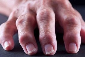 Die Hauptunterschiede von Arthritis und Arthrose