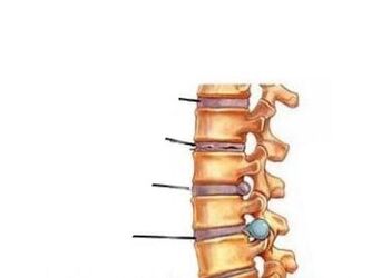 Vier Entwicklungsstadien der Osteochondrose